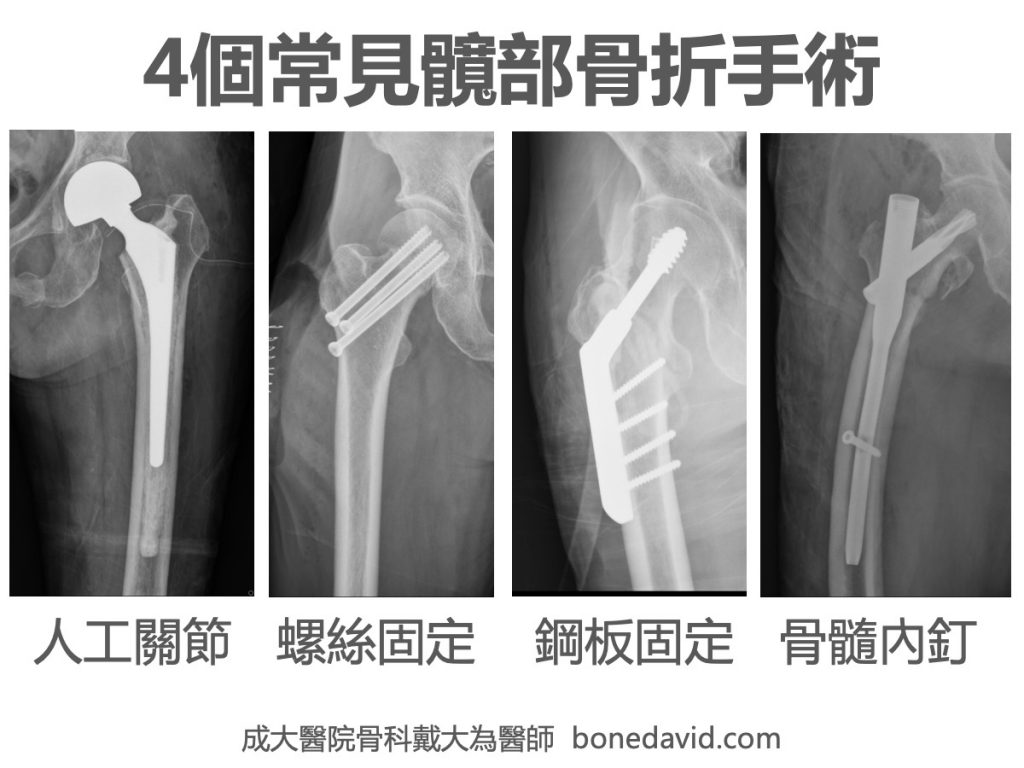 【骨質疏鬆】為什麼我打鋼釘，他換關節？骨科醫師談【髖部骨折】常見的4種手術方式